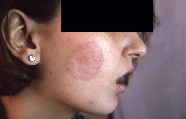 SUPERFICIAL FUNGAL INFECTIONS - Tinea faciale