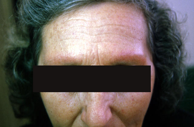 FOLLICULAR SYNDROMES WITH INFLAMMATION AND ATROPHY - Ulerythema ophryogenes FOLLICULAR SYNDROMES WITH INFLAMMATION AND ATROPHY - Ulerythema ophryogenes