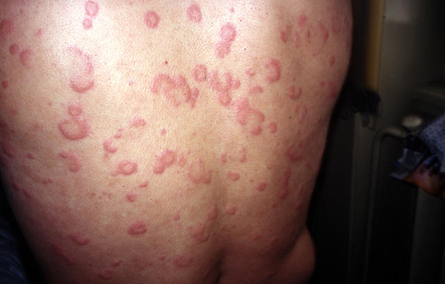 URTICARIA - Urticaria