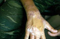 SUPERFICIAL FUNGAL INFECTIONS - Tinea infection