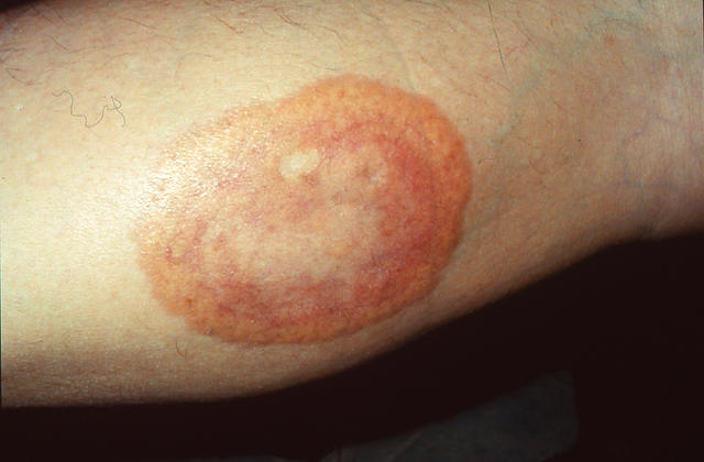 NECROBIOTIC DISORDERS - Granuloma Annulare NECROBIOTIC DISORDERS - Granuloma Annulare