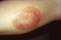 NECROBIOTIC DISORDERS - Granuloma Annulare