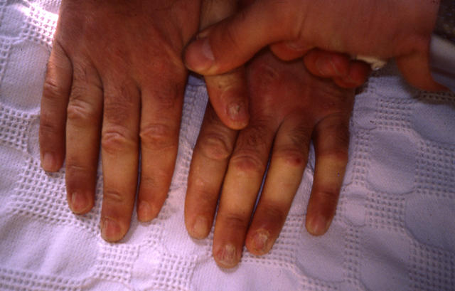 NAIL DISEASES - Lichen planus of the nails NAIL DISEASES - Lichen planus of the nails