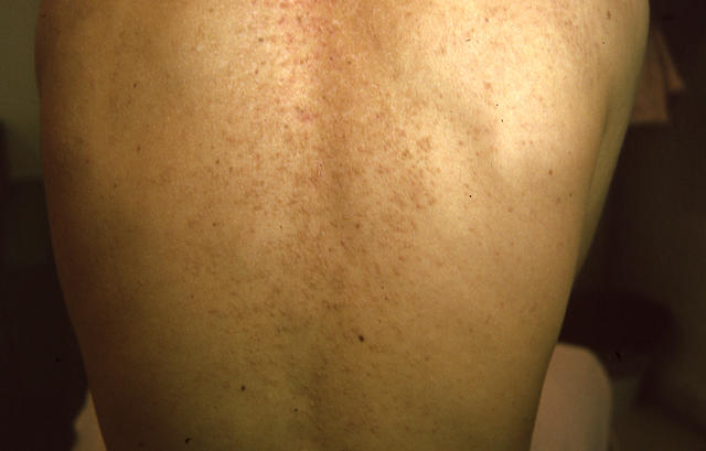 KERATINISATION DISORDERS - Darier disease KERATINISATION DISORDERS - Darier disease