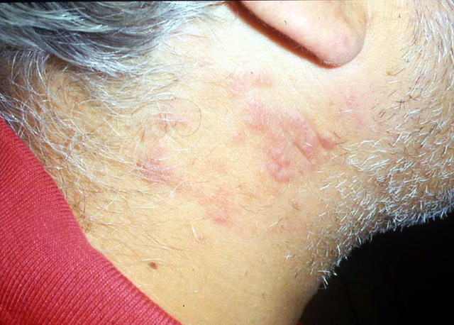 SUPERFICIAL FUNGAL INFECTIONS - Tinea SUPERFICIAL FUNGAL INFECTIONS - Tinea