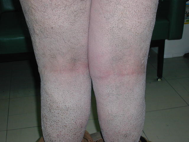 GENODERMATOSES - Ichtyosis vulgaris GENODERMATOSES - Ichtyosis vulgaris