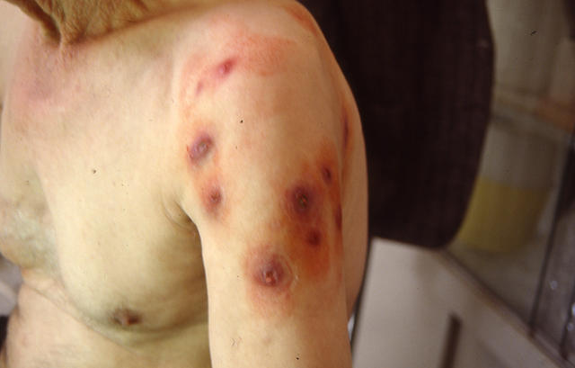 BACTERIAL INFECTIONS - Furunculosis BACTERIAL INFECTIONS - Furunculosis