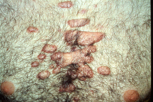 SOFT TISSUE TUMORS - Cheloids SOFT TISSUE TUMORS - Cheloids