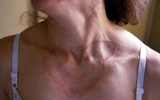 NECROBIOTIC DISORDERS - Granuloma Annulare