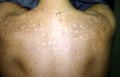 CONNECTIVE TISSUE DISORDERS - Acne, Atrophic and Hypertrophic scars