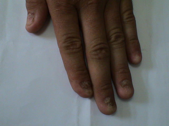 NAIL DISEASES - Lichen planus of the nails NAIL DISEASES - Lichen planus of the nails