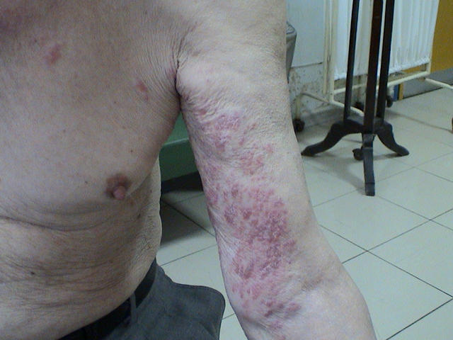 VIRAL INFECTIONS - Herpes Zoster VIRAL INFECTIONS - Herpes Zoster