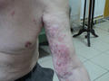 VIRAL INFECTIONS - Herpes Zoster