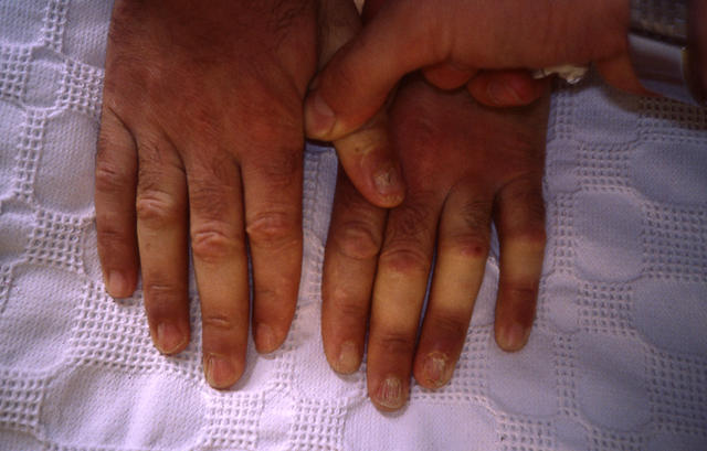 NAIL DISEASES - Lichen planus of the nails