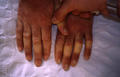 NAIL DISEASES - Lichen planus of the nails