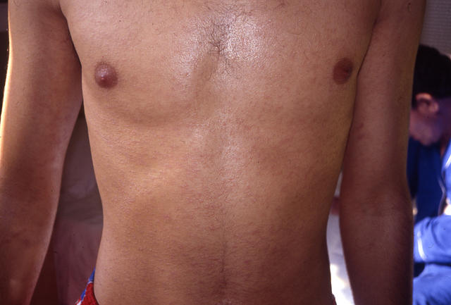 LICHEN - Lichen planus, annular LICHEN - Lichen planus, annular
