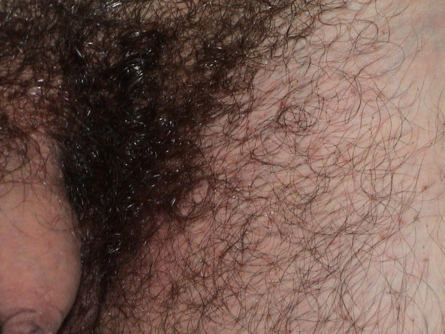 PARASITOSES, BITES - Lice PARASITOSES, BITES - Lice