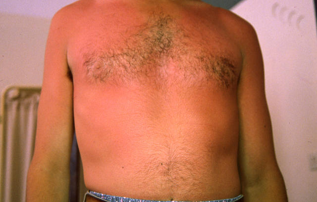 AGEING, PHOTOAGEING - Solar burn AGEING, PHOTOAGEING - Solar burn