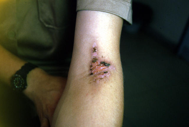 DERMATITIS - EKZEMA - Dermatitis, Contact, toxic DERMATITIS - EKZEMA - Dermatitis, Contact, toxic