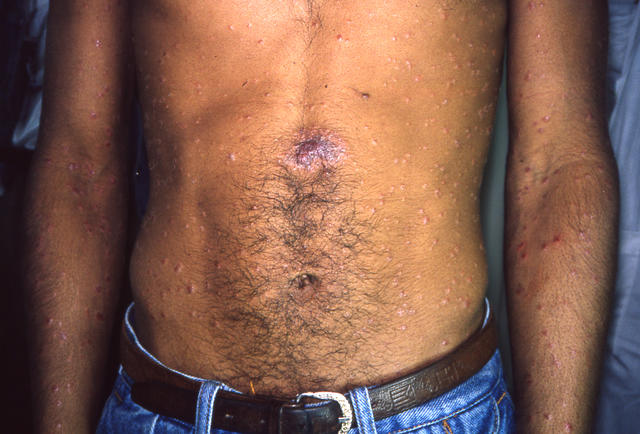 SYPHILIS AND OTHER SEXUAL TRANSMITTED DISEASES - Secondary syphilis SYPHILIS AND OTHER SEXUAL TRANSMITTED DISEASES - Secondary syphilis