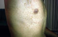 SUPERFICIAL FUNGAL INFECTIONS - Pityriasis versicolor