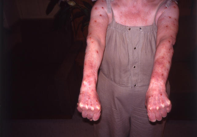 PARASITOSES, BITES - Insect bites PARASITOSES, BITES - Insect bites