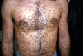 MASTOCYTOSES - Urticaria Pigmentosa