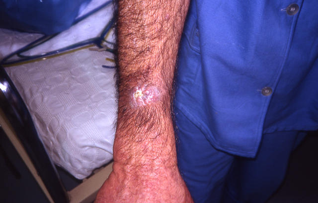 MALIGNANT LESIONS - Squamous Cell Carcinoma (SCC)