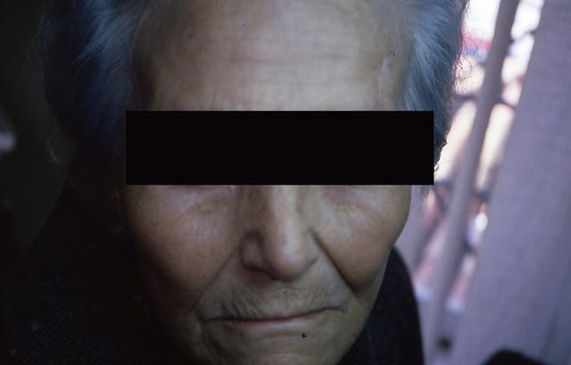 METABOLIC DISEASE, NUTRITION - Xanthelasma