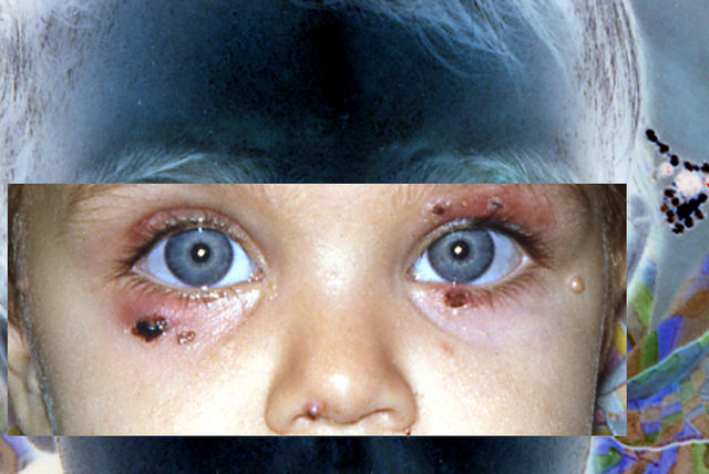 VIRAL INFECTIONS - Mollescum contagiosum VIRAL INFECTIONS - Mollescum contagiosum