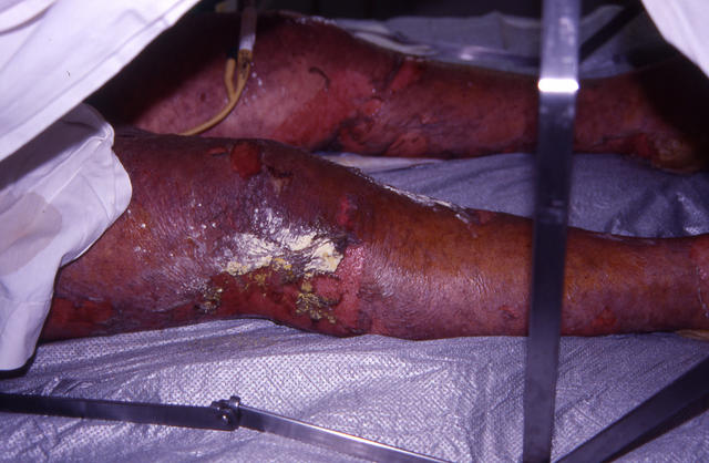 DRUG ERUPTIONS - Stevens - Johnson syndrome DRUG ERUPTIONS - Stevens - Johnson syndrome
