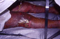 DRUG ERUPTIONS - Stevens - Johnson syndrome