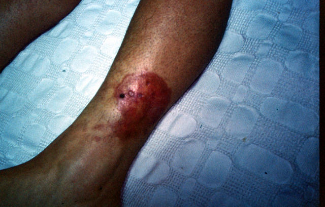NECROBIOTIC DISORDERS - Necrobiosis lipoidica NECROBIOTIC DISORDERS - Necrobiosis lipoidica