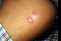 PARASITOSES, BITES - Cutaneous leishmaniasis