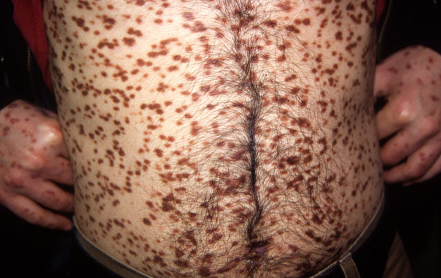 MASTOCYTOSES - Urticaria Pigmentosa