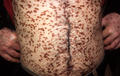 MASTOCYTOSES - Urticaria Pigmentosa