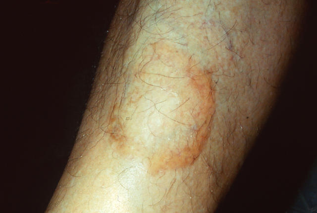 NECROBIOTIC DISORDERS - Granuloma Annulare