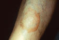 NECROBIOTIC DISORDERS - Granuloma Annulare