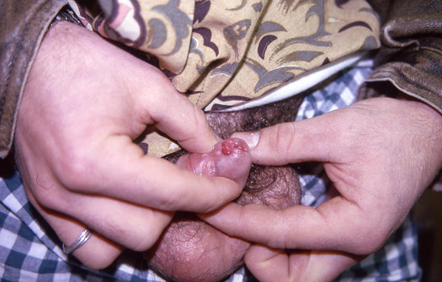 VIRAL INFECTIONS - Condylomata acuminata VIRAL INFECTIONS - Condylomata acuminata