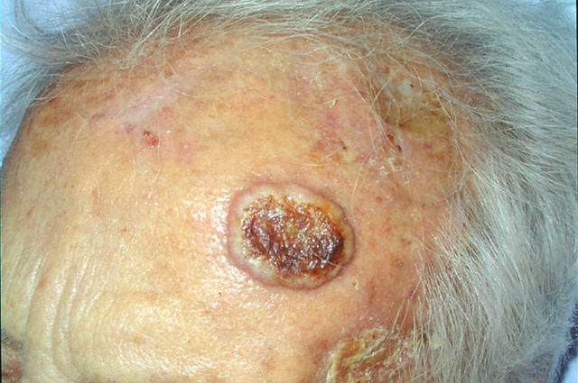 MALIGNANT LESIONS - Basal Cell Carcinoma