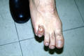 KERATINISATION DISORDERS - Callus