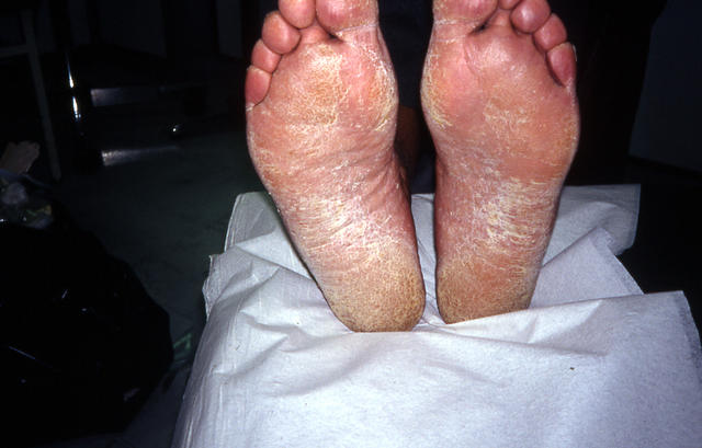 SUPERFICIAL FUNGAL INFECTIONS - Tinea pedis (Athlet's foot)