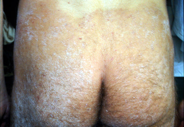 SUPERFICIAL FUNGAL INFECTIONS - Tinea infection, multiple lesions