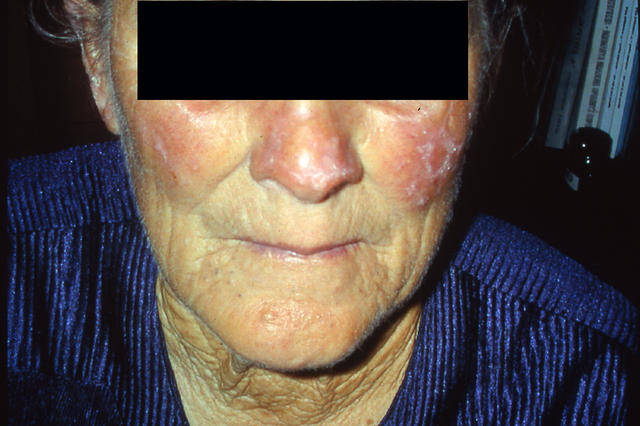 CONNECTIVE TISSUE DISORDERS - Systemc lupus erythematosus CONNECTIVE TISSUE DISORDERS - Systemc lupus erythematosus