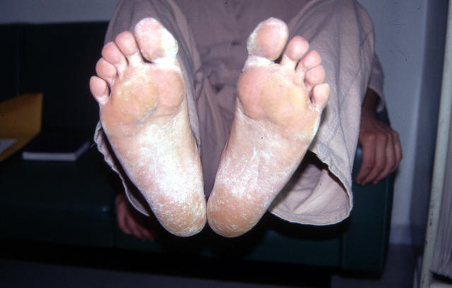 SUPERFICIAL FUNGAL INFECTIONS - Tinea pedis (Athlet's foot)