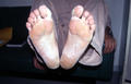 SUPERFICIAL FUNGAL INFECTIONS - Tinea pedis (Athlet