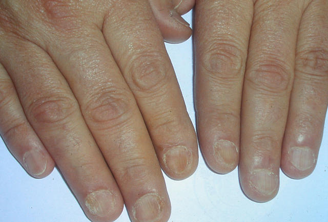 NAIL DISEASES - Lichen planus of the nails