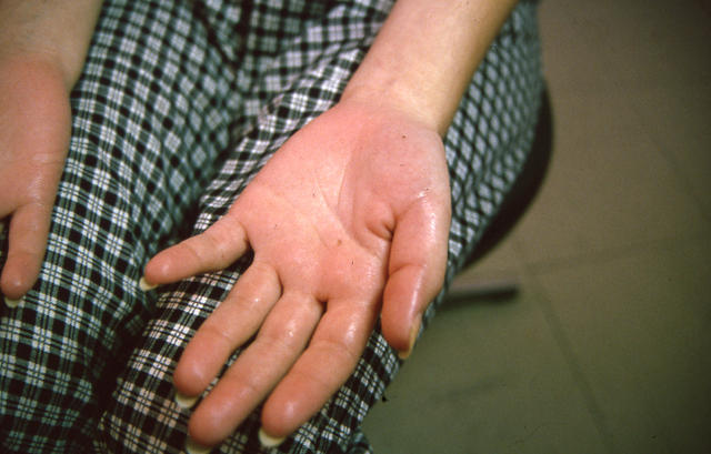 PIGMENTATION DISORDERS - Peutz - Jeghers syndrome