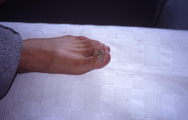 NAIL DISEASES - Onychogryphosis NAIL DISEASES - Onychogryphosis
