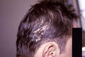 HAIR DISEASES - Pseudomonilethrix